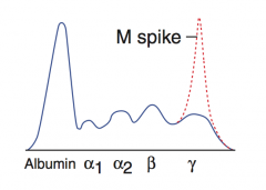 M spike on serum protein electrophoresis (indicating monoclonal Ab production)