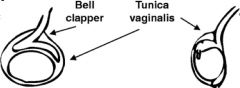 • bell clapper deformity casued by peritoneal investiture of tistis lying on cord
• abnormal insertion of tunica vaginalis >> spermatic cord can twist