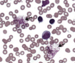 - Smudge cells in periphreal blood smear
- Auto-immune hemolytic anemia