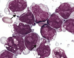 - Myeloblasts containing Auer rods
- Seen in Acute Myelogenous Leukemia (AML)