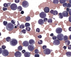 - Myeloid stem cell proliferation
- Presents with ↑ neutrophils, metamyelocytes, and basophils
- Splenomegaly