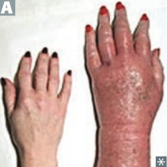 Erythromelalgia - severe, burning pain and reddish or bluish discoloration due to episodic blood clots in vessels of the extremities