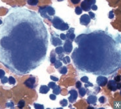 Enlarged megakaryocytes → overproduction of abnormal platelets → bleeding, thrombosis