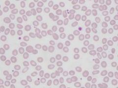 a-/aa (one gene deletion)
low top borderline Hb
low to bordeline MCV, MCH, MCHC
Normal or high RCC
less severe than beta thal
hypochromic/microcytic blood film