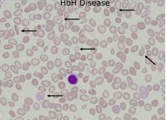 Moderate chronic haemolytic anaemia
Hb = 60 ‐ 100 g/L
low MCV, MCH, MCHC
?nRBC
reticulocytosis
basophilic stippling uncommon
