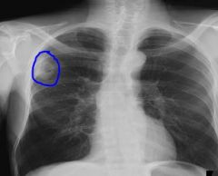 Cavitated pulmonary nodule 