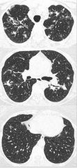 Upper zone - multiple small pulmonary nodules; many other variations (no pulmonary findings, alveolar, focal)  