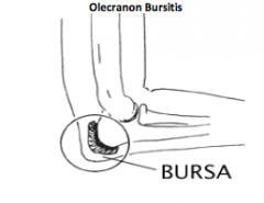 Etiology of olecranon bursitis