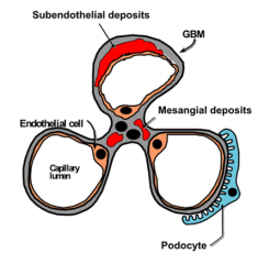 - LM: hypercellular glomeruli, endocapillary cell proliferation, lobular appearing glomeruli

- IF: granular C3 deposition

- EM: subendothelial deposits