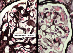 Membranous Nephropathy