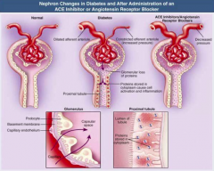 - Dilated afferent arteriole (glucose-dependent, via vasoactive mediators VEGF, NO, TGF-B)
- Constricted efferent arteriole (increased pressure)
- Glomerular loss of proteins
- Proteins stored in cytoplasm cause cell activation and inflammation