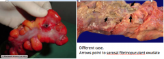 Sigmoid Colonic Diverticulitis and Abscess:
 
Because the wall of the diverticulum is supported only by the _____
 and a thin layer of subserosal adipose tissue, inflammation and increased pressure
 within an obstructed diverticulum can lead to __...