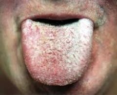 Benign oral condition