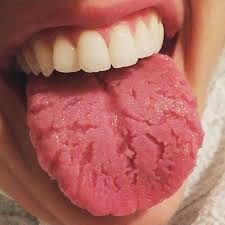 Benign oral condition