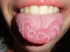 Benign oral condition