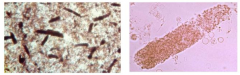 - Casts: caused by trapping of cellular elements in matrix of protein secreted by renal tubule cells
- Granular casts ("muddy brown urine") seen in cases of acute tubular necrosis