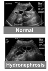 Hydronephrosis - distension and dilation of renal pelvis calyces