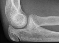 A 13-year-old pitcher develops pain over the lateral aspect of his throwing elbow. He has an effusion and a painful click on passive elbow rotation. What is the most likely diagnosis? 1-Tommy John lesion; 2- PLRI 
3-OCD; 4-Stress fx; 5-Plica synd