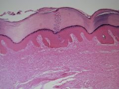medium magnification of ____ _____ ____ epithelium from the _____. The thick layer is dead, keratinized layer called ___ ____. Inferior to the epithelium is the dense connective tissue layer called the ___. Penetrating the top layer are ___ of the...