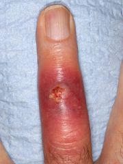 MC'ly reported risk factor for development of CA-MRSA is injury to the skin. The majority of infections occur in body most susceptible to skin trauma, and reports suggest that players involved in frequent, repetitive contact (such as linemen and l...