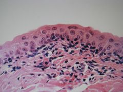 high magnification of ___ epithelium in the ___ ___. Below the stretched epithelium are connective tissue and blood vessels. 
