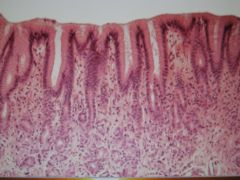 a low magnification of ___ ____ in the ___ tract. ___ ____ epithelium lines its surface. The fusiform cells scattered between the collagen fibers are most likely ____. 