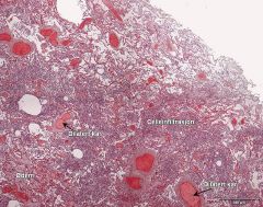 Bakteriell pneumoni
Spørsmål: Hvilke to typer patologiske forandringer dominerer bildet?
- Du ser celleinfiltrasjon og dilaterte kar.
