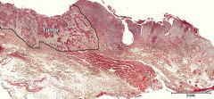Plateepitelcarcinom i hud
Spørsmål: Hvilken del av prepatatet representerer tumor?
- Se stiplet område på bildet