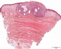 Basalcellecarcinom
Spørsmål: Kan du se området med patologiske forandringer i huden?
- Se stiplet linje på bilde.
