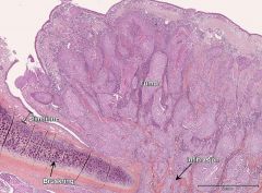 Plateepitelcarcinom i lunge A
Spørsmål: Hvor er tumor og hvordan ser du at tumor er relatert til sentral luftvei?
- En kan se slimhinne med bruskring, og det viser at tumor er relatert til sentral luftvei.
Det er her infiltrasjon gjennom bronkiegren.