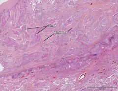 Plateepitelcarcinom i lunge B
Spørsmål: Hva representerer de fiolette øyene og hva er de rødgule dragene?
- Henholdsvis tumorvev og bindevev. Bindevevet induseres av tumorvevet.