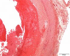 Spørsmål 1: Hvor går grensen mellom trombematerialet og arterieveggen?

Spørsmål 2: Er det patologiske forandringer i selve arterie-veggen?
