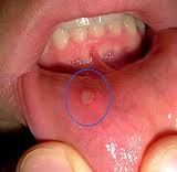 aphthous ulceration of mouth
