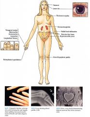 Nail-Patella Syndrome Flashcards 