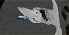 Radiology Assistant: Temporal Bone Flashcards - Cram.com
