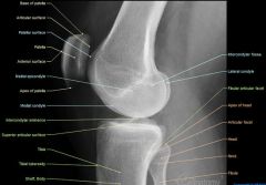UCSF: Video e 48 Part 8 MSK Skeletal trauma (Learning Radiology Knee