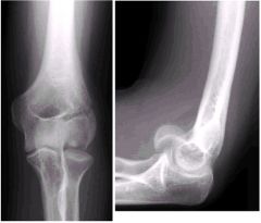 X-Ray Fracture Practice 1 Flashcards - Cram.com