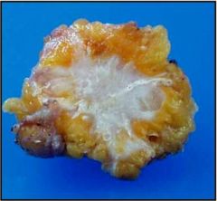 invasive ductal carcinoma gross