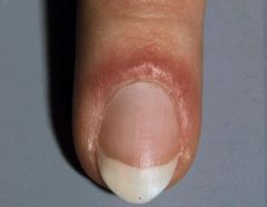 skin hair and nails- pt dx and eval Flashcards 